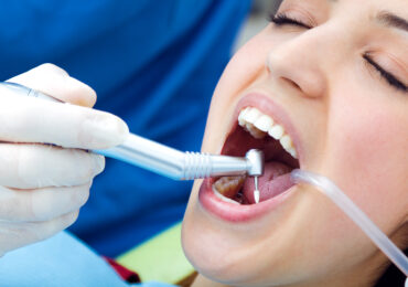 Dental Fillings in Wakad