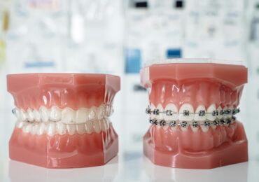 Orthodontics Treatment in Wakad