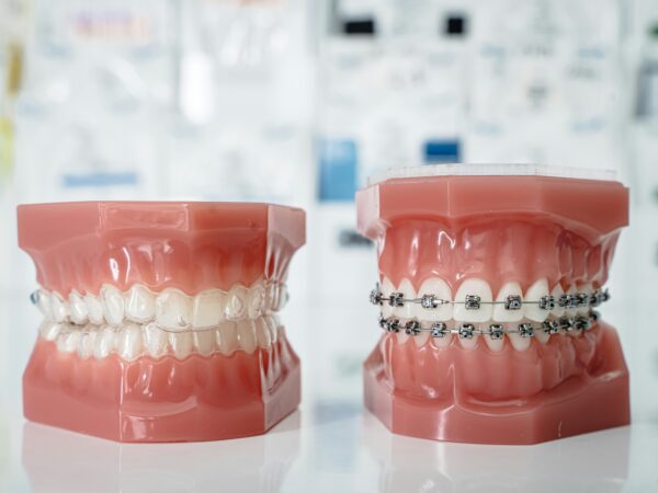 Orthodontic Treatment in Wakad