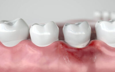 Gums Healthy